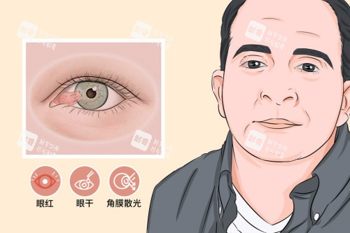 翼状胬肉症状 翼状胬肉症状