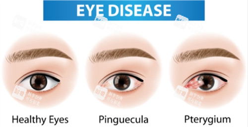 不同程度的翼状胬肉 不同程度的翼状胬肉