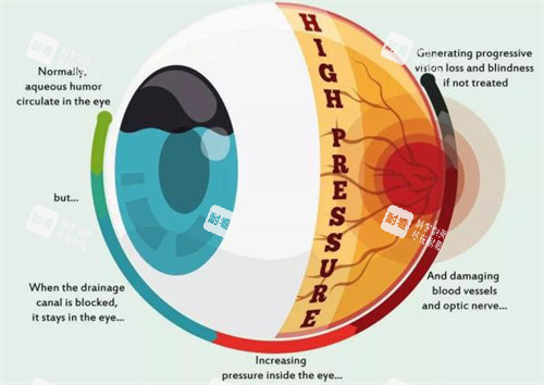 青光眼眼压和房水都有问题