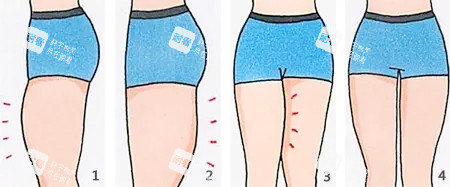 大腿吸脂卡通图