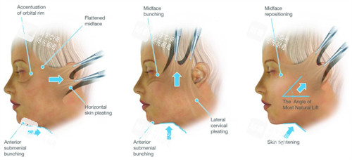 拉皮手术不同角度