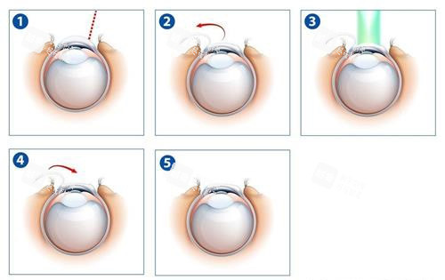 激光近视眼手术示意图 激光近视眼手术示意图