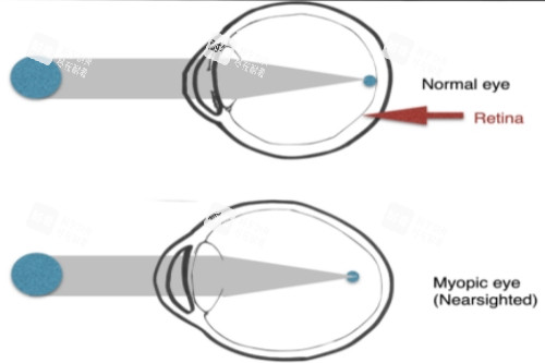 正常眼与近视眼对比 正常眼与近视眼对比
