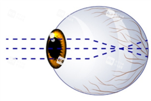 近视眼球示意图