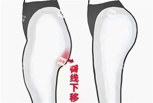 臀部脂肪填充对比