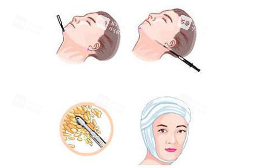 面部吸脂过程示意图