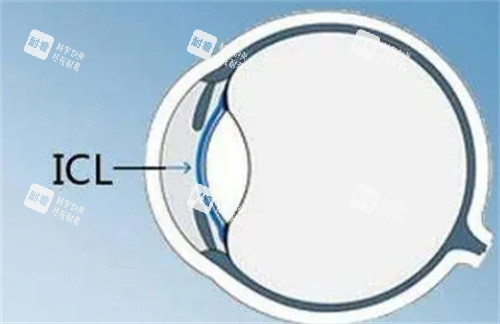 ICL晶体V5