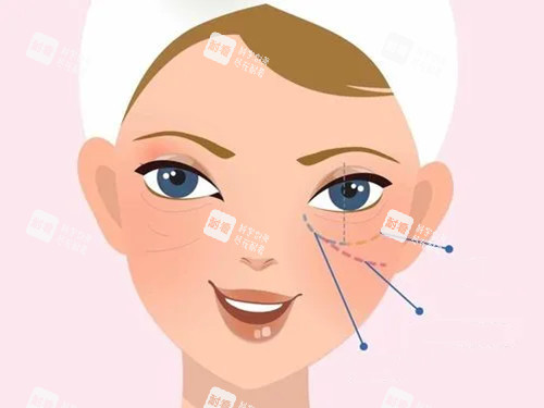 眼周不同位置示意图
