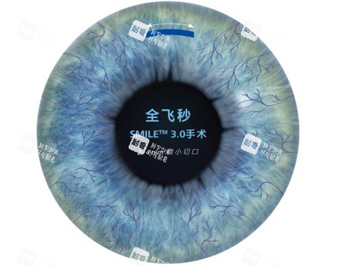 半飞秒手术卡通图 半飞秒手术卡通图