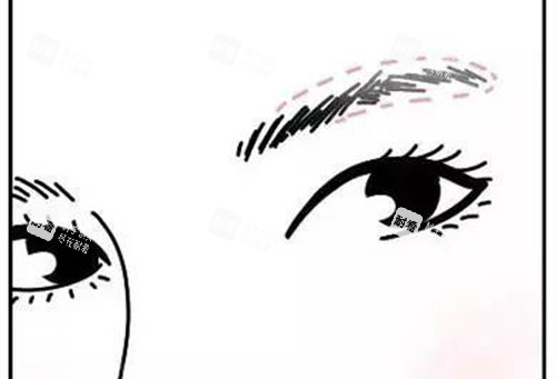 眉弓填充位置示意图