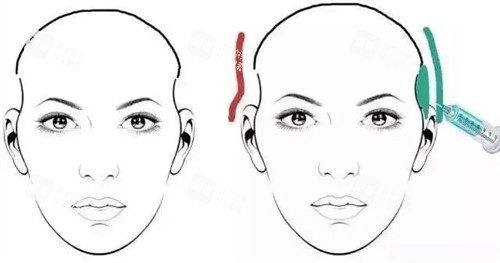 太阳穴凹陷玻尿酸注射对比动画图