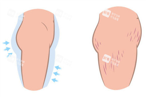 瘦身后大腿留下的肥胖纹