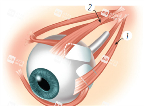 后巩膜加固术演示