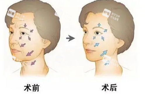 面部抗衰前后对比卡通示意图