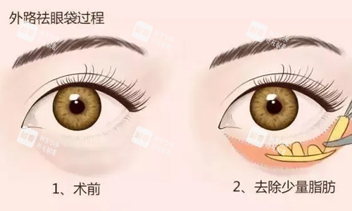 外切祛眼袋展示 外切祛眼袋展示