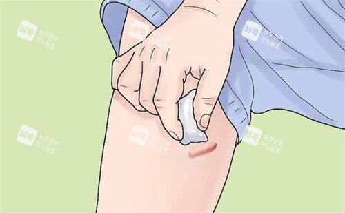 疤痕疙瘩怎么护理