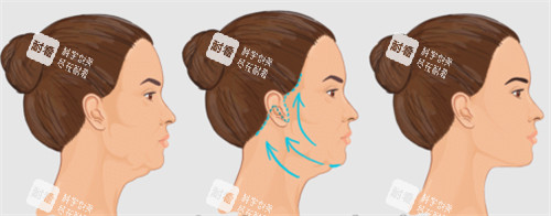 面部提升改善皮肤状态
