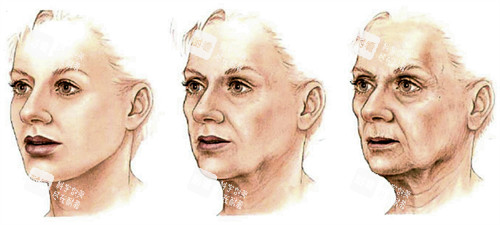 面部提升的皮肤前后对比