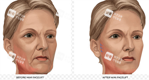 改善皮肤皱纹的面部提升
