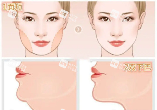 面部吸脂示意图 面部吸脂示意图