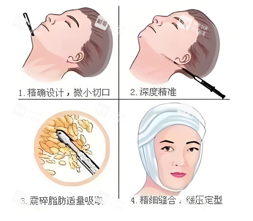 面部吸脂步骤动画演示图 面部吸脂步骤动画演示图