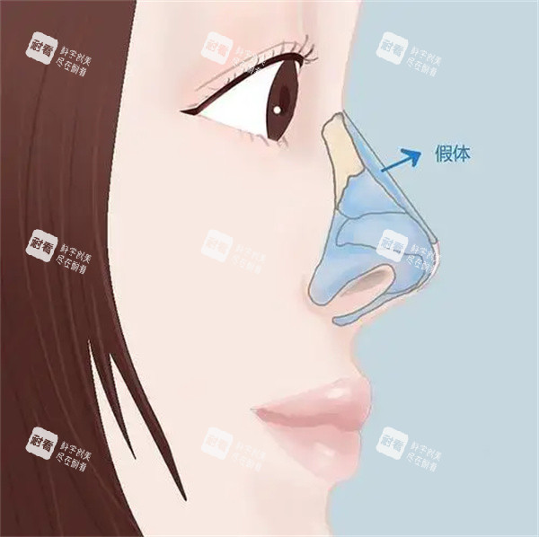 假体隆鼻整形手术