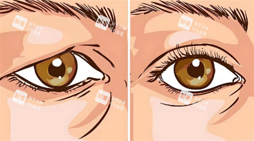 提眉前后变化有哪些 提眉前后变化有哪些