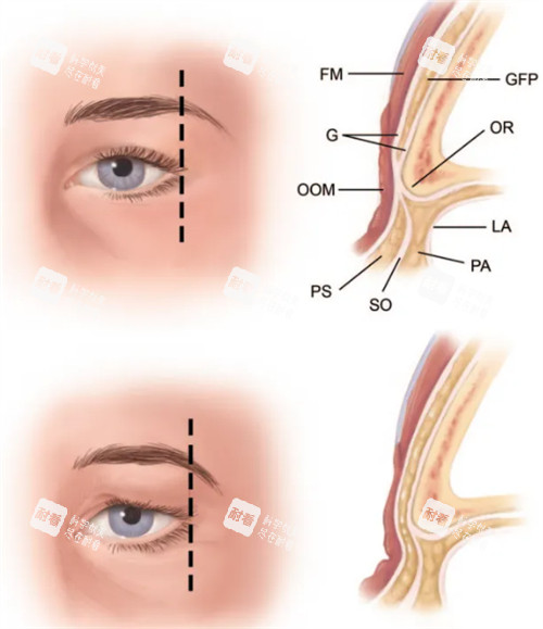 提眉手术层次高清解析 提眉手术层次高清解析