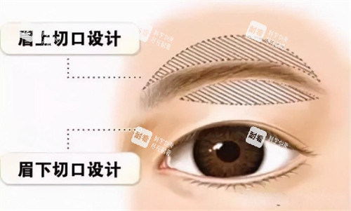 提眉手术切口动画演示图