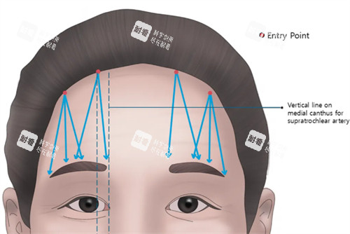 提眉前后对比分享