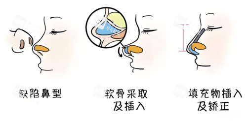 鼻综合手术过程动画