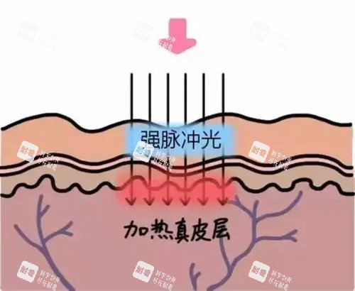 光子嫩肤针对的皮肤层