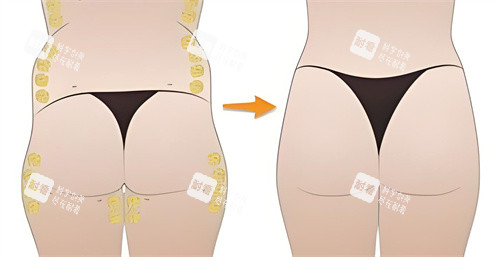 臀部吸脂手术脂肪部位演示动画图