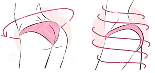 提臀手术呈现图