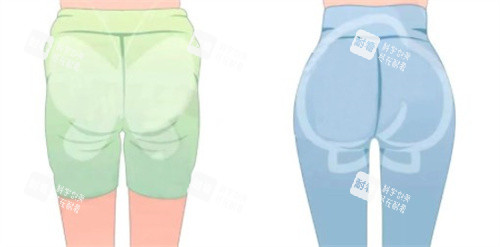 臀部整形前后对比