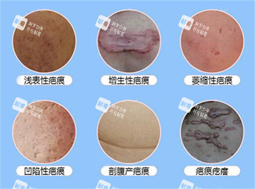 常见的疤痕有哪些 常见的疤痕有哪些