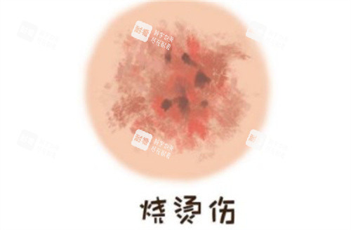 烧烫伤疤痕 烧烫伤疤痕