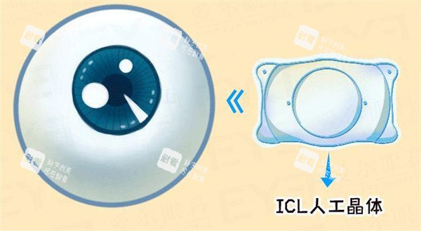 ICL人工晶体图示