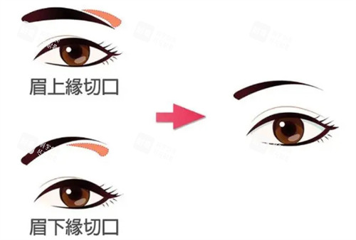 提眉的不同切口参考