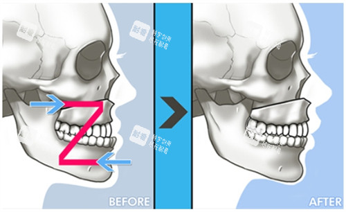 双鄂手术的过程及对比 双鄂手术的过程及对比