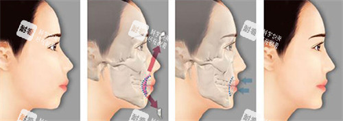 双鄂手术前后对比图片 双鄂手术前后对比图片