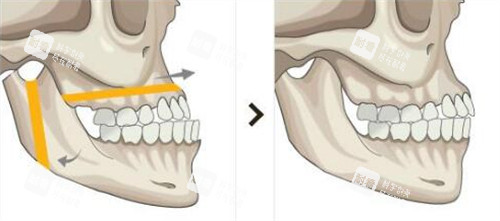 双鄂手术前后对比图 双鄂手术前后对比图