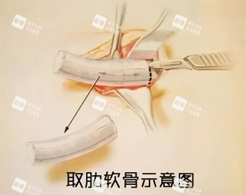 肋骨鼻手术过程图