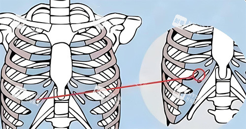 隆鼻肋骨鼻所用肋骨图