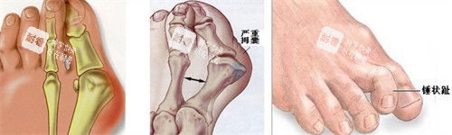大脚骨的表现