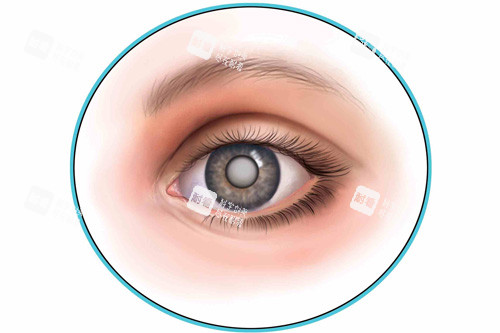 白内障示意图 白内障示意图
