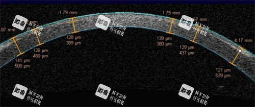 飞秒激光角膜瓣厚度