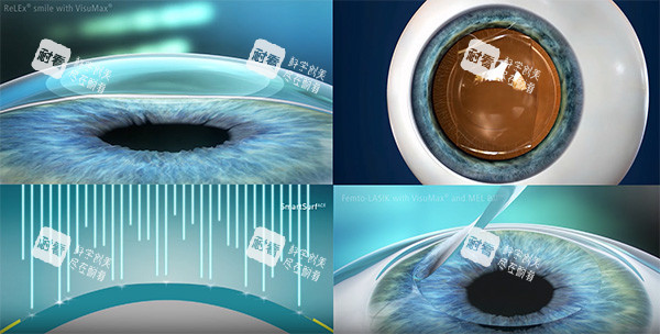 麦迪格飞秒技术原理图片 麦迪格飞秒技术原理图片