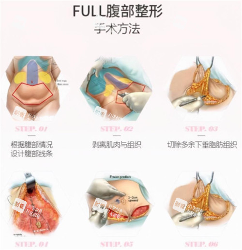 腹壁成形术手术过程图解 腹壁成形术手术过程图解