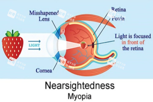 近视视物落在视网膜前